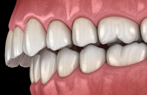 Illustration of an overbite
