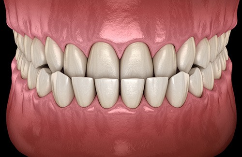 Illustration of an underbite