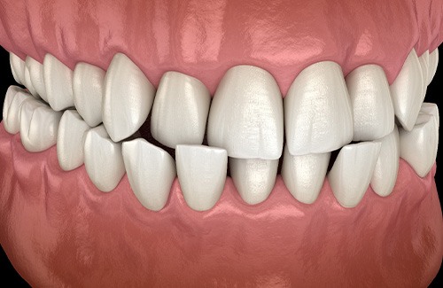 Illustration of a crossbite