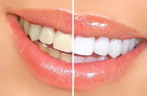 Before and after teeth whitening