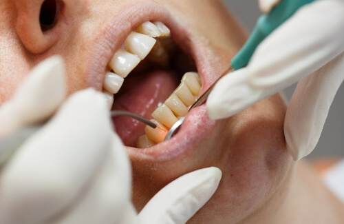 Close up of dentist treating gums with a laser