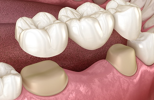 A 3D illustration of a traditional dental bridge