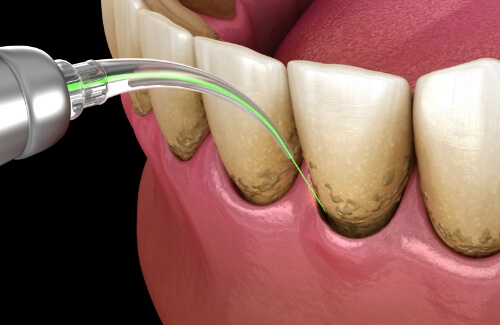 Illustrated dental laser treating gum disease