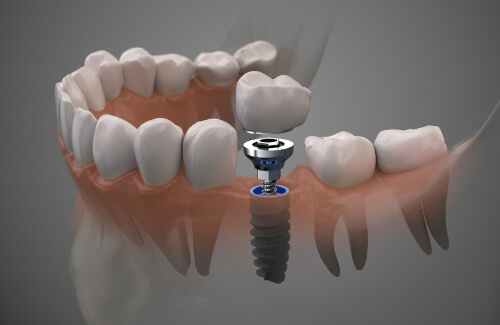 Illustrated dental crown being fitted onto a dental implant