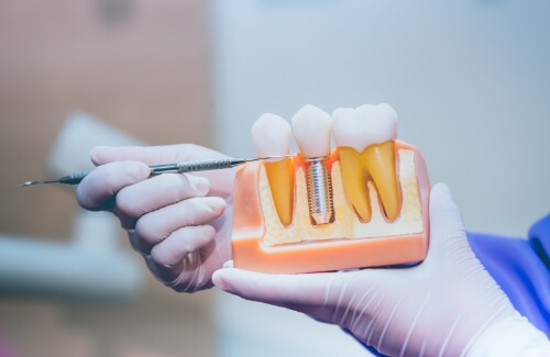 Dentist holding a model of a dental implant