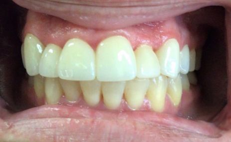 Smile with whiter teeth after treatment from Grantsville dentist