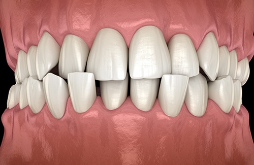 Patient in Grantsville with bite alignment issues