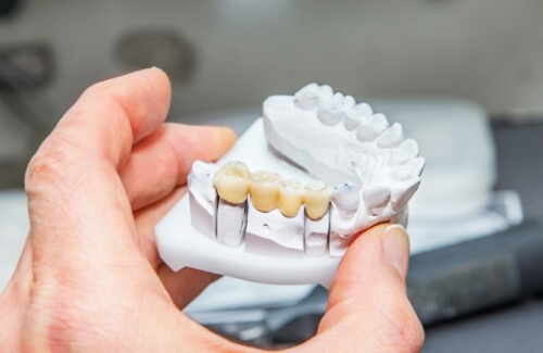 Hand holding model of the mouth with dental bridge over three teeth