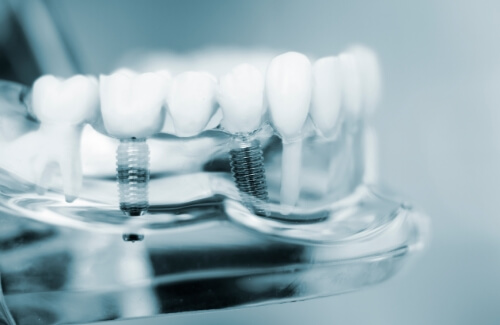 Model of the mouth with two dental implants