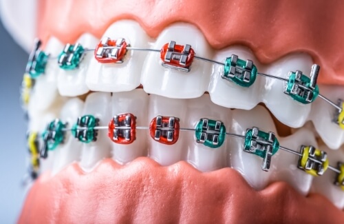 Model of the mouth with braces with multicolored brackets