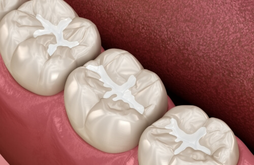 Illustrated row of teeth with dental sealants