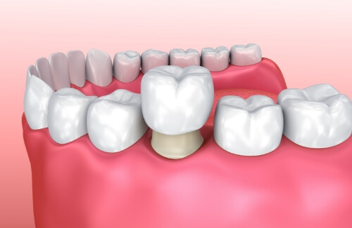 Illustrated dental crown being fitted over a tooth