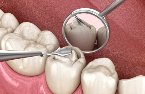 Illustrated white filling being placed inside of a tooth