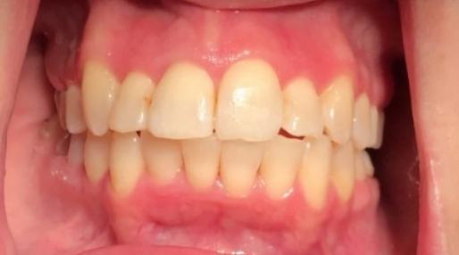 Close up of smile with yellowed teeth before treatment from Grantsville dentist