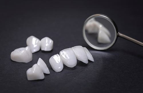 Example of veneers in Grantsville