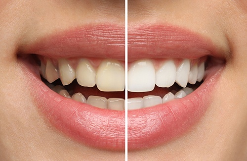 Closeup of a smile that’s half whitened to show before/after treatment resutls