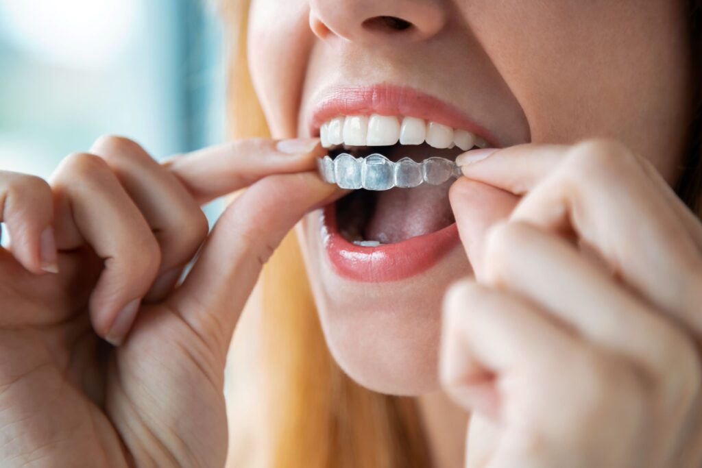 Nose-to-neck view of redhead removing Invisalign from upper arch